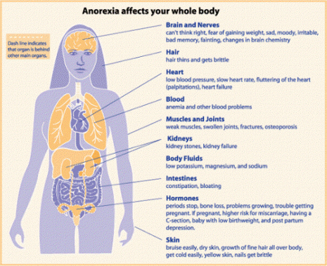 Diagram showing the affects on the body of Anorexia Nervosa
