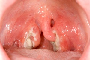 tonsillitis2