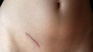 Salpingectomy Scar